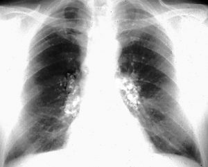 Lungs with Silicosis from Respirable Crystalline Silica